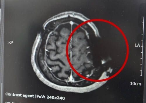 뇌종양 수술을 받으면서 부러진 쇠톱 날이 그대로 머리뼈에 박힌 채 봉합이 이뤄지면서 제대로 촬영이 이뤄지지 않는 A씨의 MRI 사진. [사진출처=연합뉴스]
