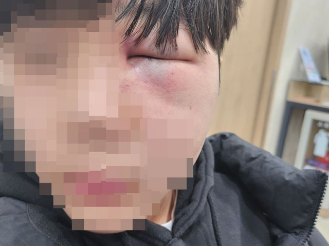 폭행으로 망막이 훼손된 학생 얼굴. [사진=연합뉴스]