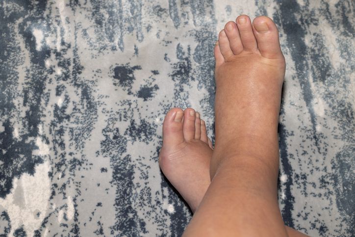 비브리오패혈증 올해 첫 사망자는 다리 부종·통증 및 색 변화의 증상이 나타났다고 전했다. 사진은 직접적인 관련이 없습니다. [이미지출처=게티이미지]