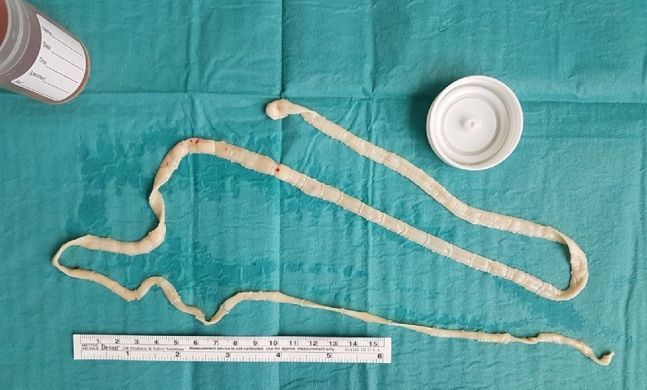 필리핀 여성의 장에서 발견된 50cm짜리 촌충 [이미지출처=국제외과학회지 사례보고서]