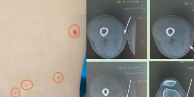 '아이어맨'처럼 금속파편 빼볼게…영화 따라하던 남성 결국