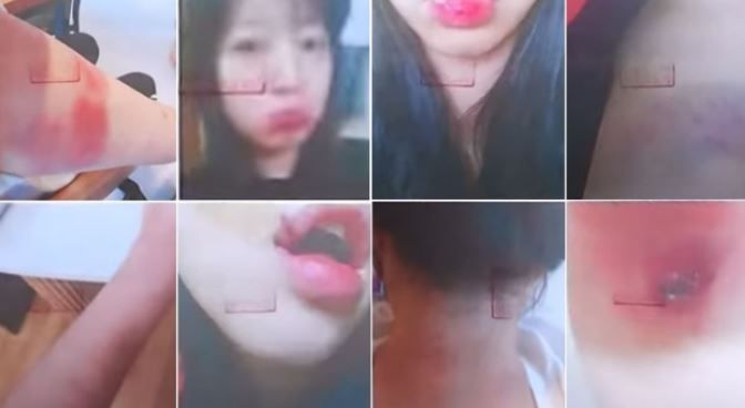 "Bruises and Bandage Wounds on Arm?"... Tzuyang's Past Broadcast Scene Revisited