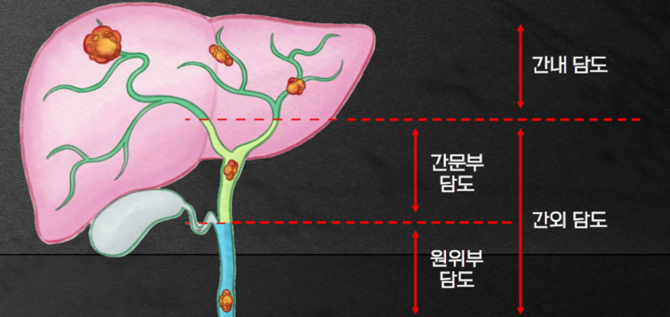 "담도암 엄마 살린 임핀지…월 1000만원은 부담" 급여 적용 청원 등장