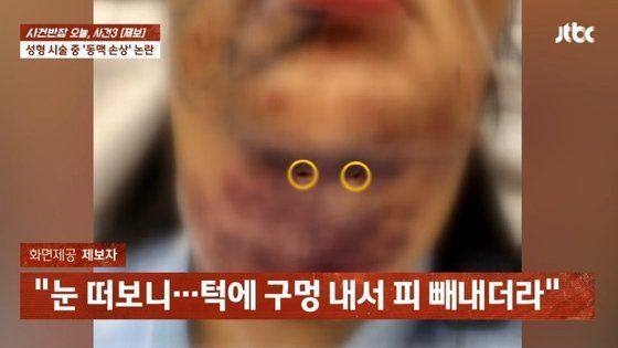 "눈 떠보니 턱에 구멍 뚫어"…지방흡입 시술 후 호흡 곤란 온 여성