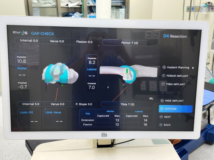 로봇수술 중 무릎 관절의 상태를 보여준다. 센텀종합병원 제공