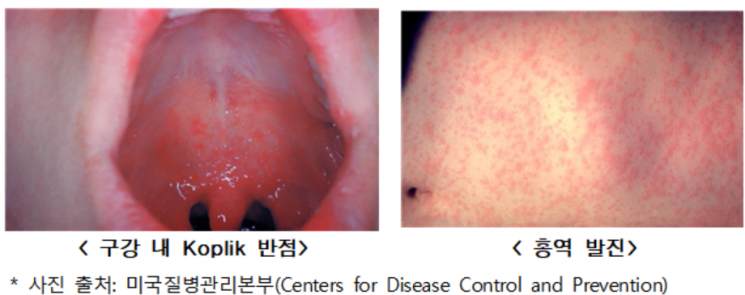 "해외여행 시 '홍역' 감염 주의"…지난해 국내환자 49명