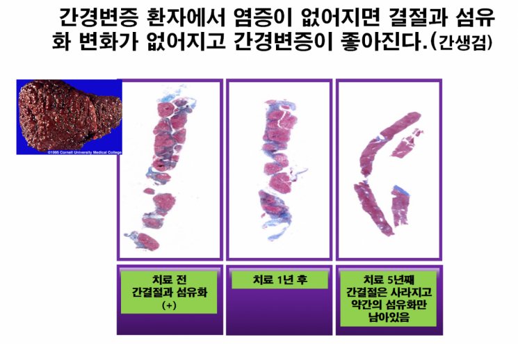 간암 예방 핵심 열쇠… “간 염증 억제 관리하는 것”
