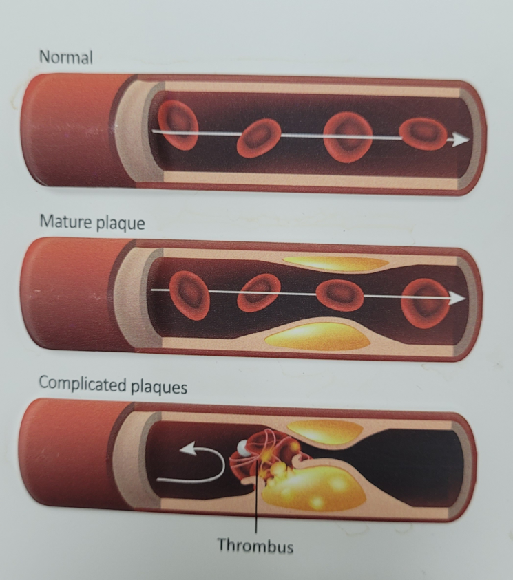 ‘혈관의 위험경고’ 이상지질혈증… 방치하면 중증질환 초래