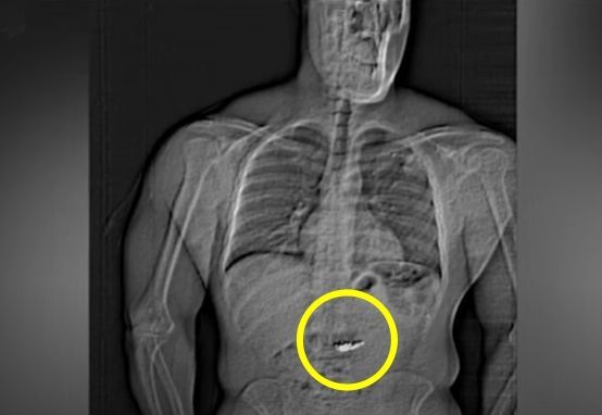 "화장실 언제 갈거야?"…11억 짜리 귀걸이 삼킨 강도에 애타는 경찰
