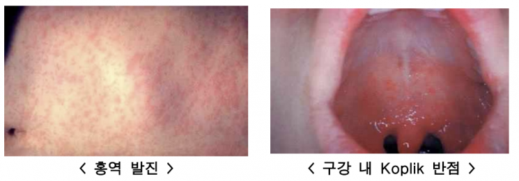전세계 홍역 유행에 국내 환자도 2배…"해외여행 전 백신 접종해야"