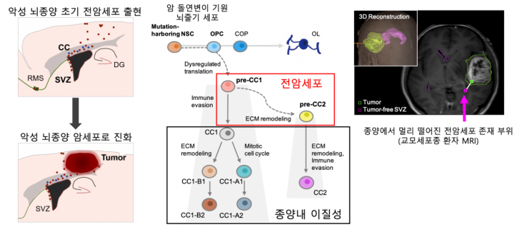 KAIST, 교모세포종 안에 '전암 세포' 세계 첫 규명