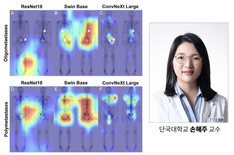 단국대병원 손혜주 교수팀, 골전이 AI 진단 기술로 '한빛사' 선정