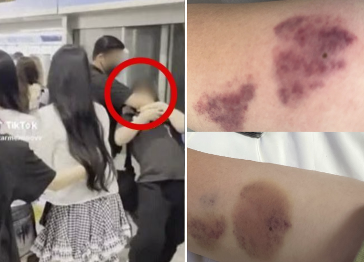 그룹 하츠투하츠 과잉 경호 논란 사건 당사자인 팬이 다친 자신의 팔 사진을 공개했다. 온라인 커뮤니티, 엑스 캡처