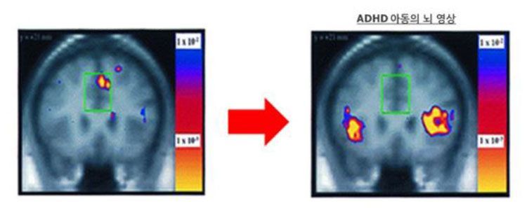 집중력이 필요한 상황에서 활성화되는 등쪽 전방 중심부 대상피질(dorsal anterior midcingulate cortex)의 활성화가 ADHD 환자(오른쪽)에서는 관찰되지 않았다. 대한소아청소년정신의학회.