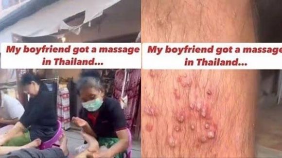 태국 여행 중 저가 마사지를 받은 뒤 다리에 심각한 염증이 생겼다는 남성의 영상이 확산하고 있다. 조 휘팅턴 박사 사회관계망서비스(SNS)