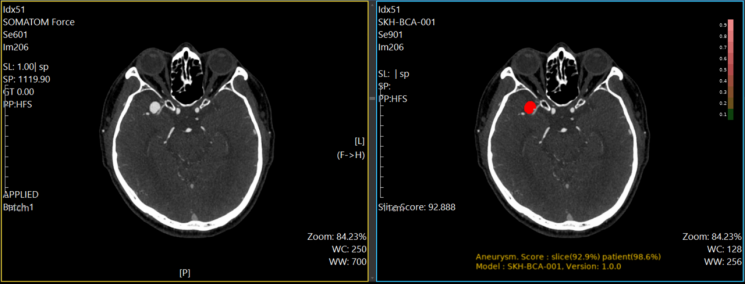 PurpleAI Receives Medical Device Approval for Cerebral Aneurysm Diagnostic AI