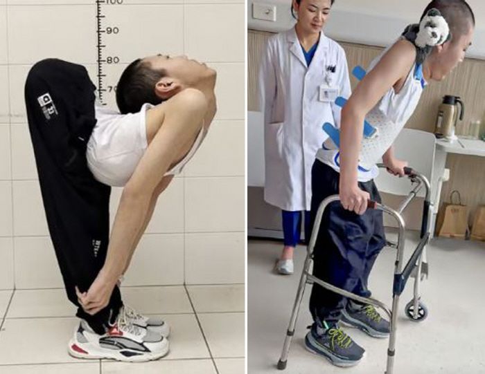 허리 180도 꺾인 소년 마침내 바로 섰다…"기적 같은 소식" 中 전역 감동 물결