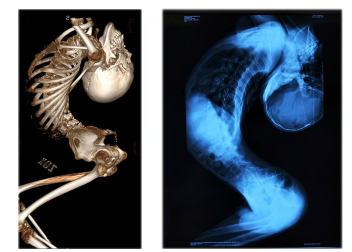 허리 180도 꺾인 소년 마침내 바로 섰다…"기적 같은 소식" 中 전역 감동 물결