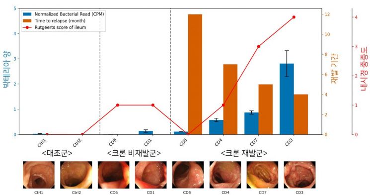 Analysis of intestinal tissue from Crohn's disease patients revealed a significant increase in microbial distribution in areas with severe inflammation. It was confirmed that the greater the extent of microbial distribution, the shorter the relapse period and the higher the severity. Yonsei Medical Center