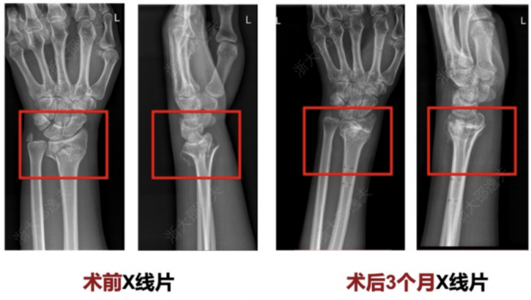 수술 전 X선 사진 과 수술 후 3개월 뒤 X선 사진. CCTV