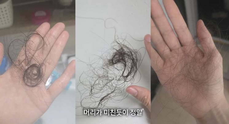 유튜버는 사건 이후 탈모 등 부작용을 겪고 있다고 토로했다. 유튜브 채널 캡처