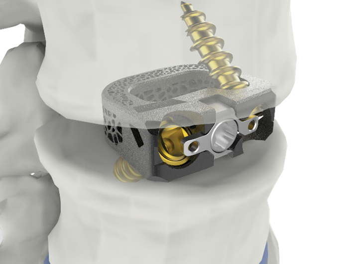 CGBio Medtech's Spinal Implant 'UniSpace' Receives FDA Clearance