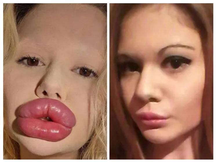 "시술 거부 당했어요"…의사도 만류한 '세상에서 가장 두꺼운 입술女'