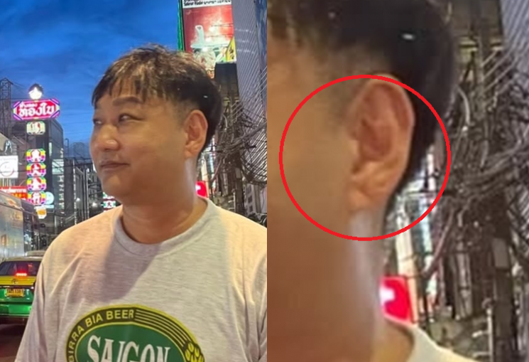 "아버지도 귀에 이 주름 있었다"…쓰러진 김수용 '프랭크 징후' 전조 증상?