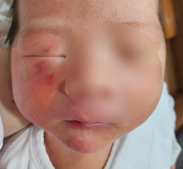 "3시간 전엔 없었어요"…신생아실 있던 '생후 4일' 아이 얼굴에 상처