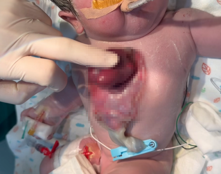 희귀 '심장이소증' 서린이, 서울아산병원서 기적을 만나다