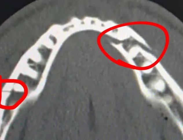 챔프 출신 한방에 턱뼈 2곳 골절…모두가 걱정했던 유튜버 근황