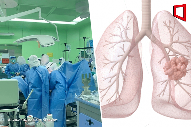 "제발 금연하세요"…15세부터 전자담배 피우다 피 토하고 폐 절제한 20대