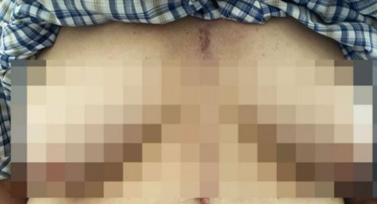 "'이 약' 먹고 가슴 커졌어요"…부작용 호소, 원인 보니