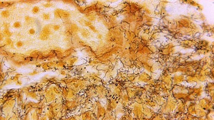 어느새 1만명 훌쩍…다시 고개 드는 '이 질병'에 보건당국 '긴장'