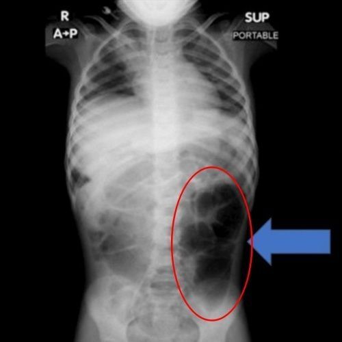 Young Girl Complaining of Abdominal Pain... A Mass of "This" Found in Her Stomach