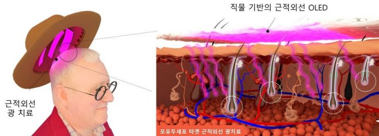 "모낭 세포 노화 92% 억제" KAIST, 모자형 '탈모 치료기' 개발