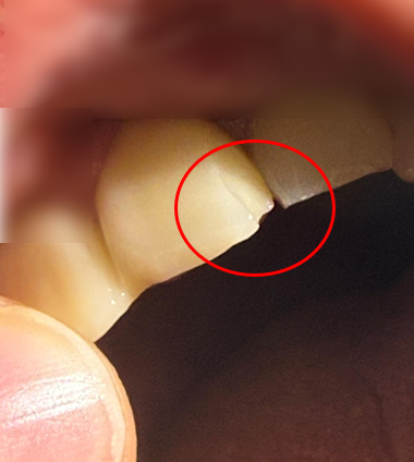 "햄버거에서 '금속 볼트' 나왔다"…치아 부서졌는데 본사는 "원인불명"