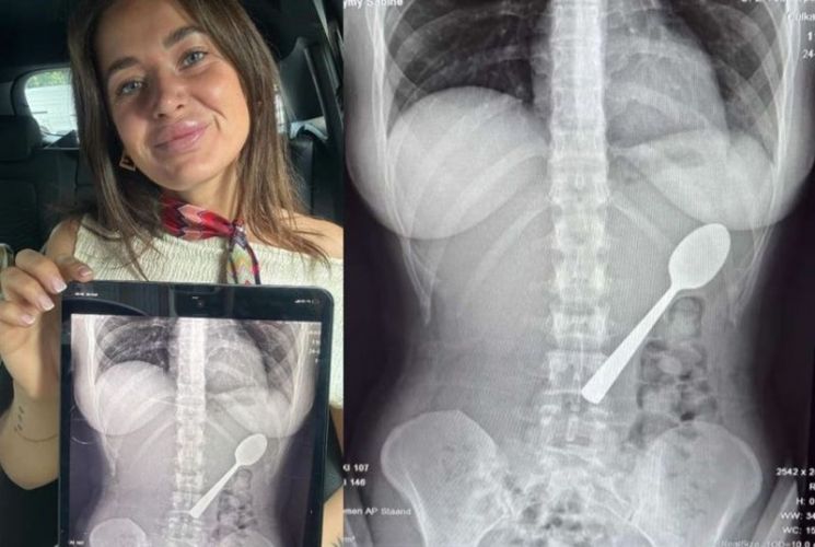 "아찔했다" 요거트 먹는데 반려견이 '펄쩍'…17cm 숟가락 삼킨 '황당 사고'