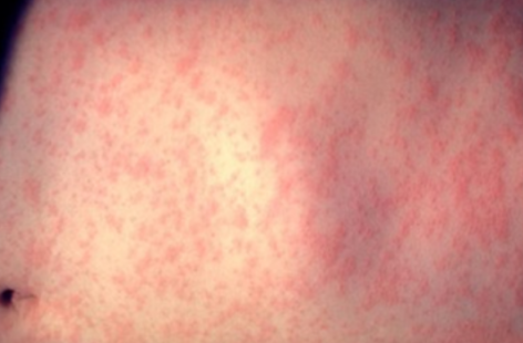 "이러다 3천명 넘는다" 상상초월 발병에…'후진국 되겠네' 싸늘한 민심