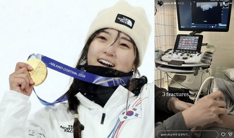 '투혼의 금메달'…스노보드 최가온 "세 군데 골절" 