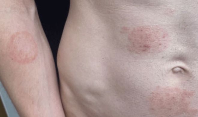 "치료 어려운데, 벌써 14명 확진"…성관계 후 '희귀 곰팡이' 집단감염 우려에 美 비상