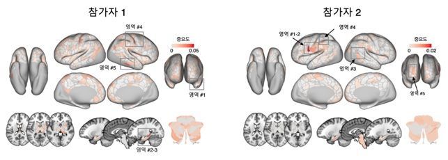"통증도 사람마다 다르다"…뇌 영상으로 만성 통증 강도 수치화[과학을읽다]