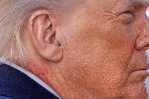 "저 자국 뭐지?" 트럼프 목 부위 '붉은 반점'…백악관 "피부 연고 때문"