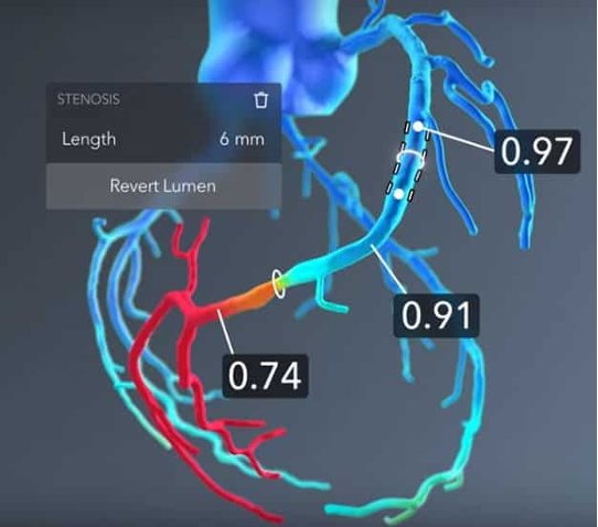 Schematic of cardiac blood flow fluid dynamics simulation. Seoul St. Mary's Hospital