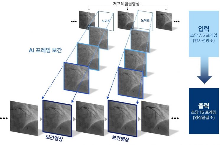 관상동맥조영술 프레임 보간 모델 Angio-FILM 모식도. 분당서울대병원