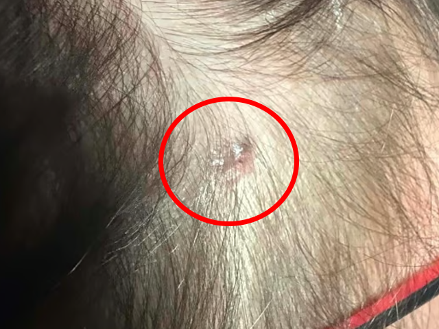 “손님 머리에 혹이…” 미용사가 샴푸 해주다 발견한 피부암