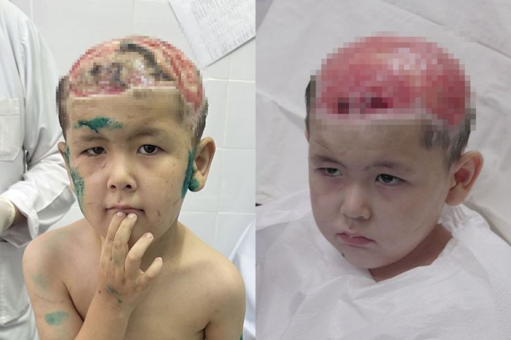지난 4월 사고 직후 키르기스스탄 국립소아병원에 입원한 우마르의 모습(왼족)과 7월 한국에 도착해 서울아산병원에서 첫 진료를 보고있는 우마르의 모습. 서울아산병원