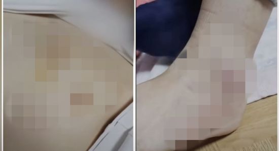 이들은 지난달 8일 A군이 '전화를 받지 않는다'는 이유로 불러내 폭행했다. 가해 학생 B군은 A군과 얼마 전까지 같은 학교에 다니다가 학교에서 폭력 행위를 일삼아 강제 전학했던 것으로 확인됐다. 전학한 이후에도 이전 학교 동급생을 불러 폭력을 행사한 것이다. [사진출처=KBS 뉴스]
